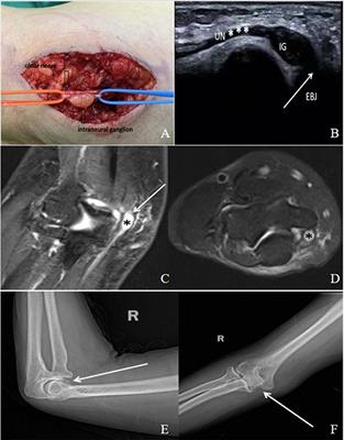 Intraneural or extraneural ganglion cysts as a cause of cubital tunnel syndrome: A retrospective observational study